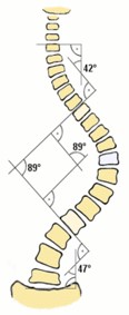 escoliosis.jpg